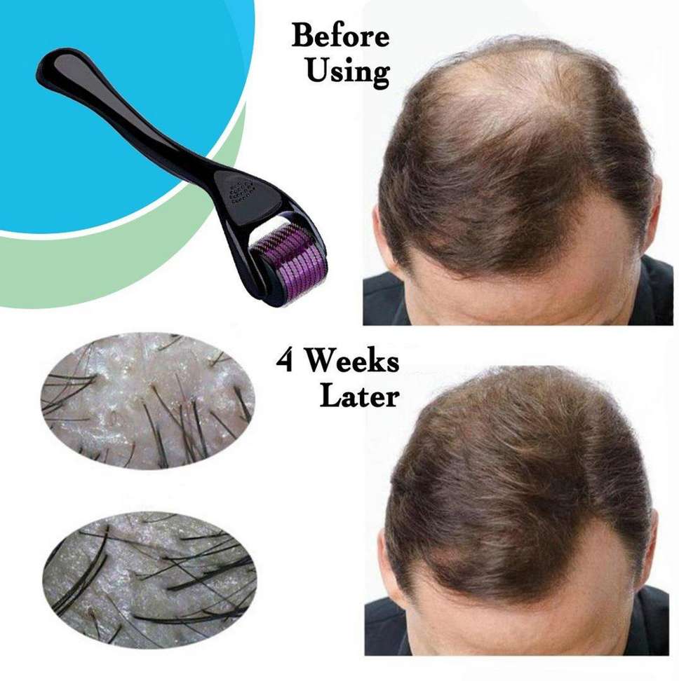 ZURU BUNCH Derma Roller 0.50mm Titanium Needles Roller Treating Face ...