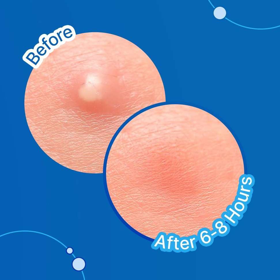Shopsy Sotrue Acne Pimple Patch 36 N - Image 3