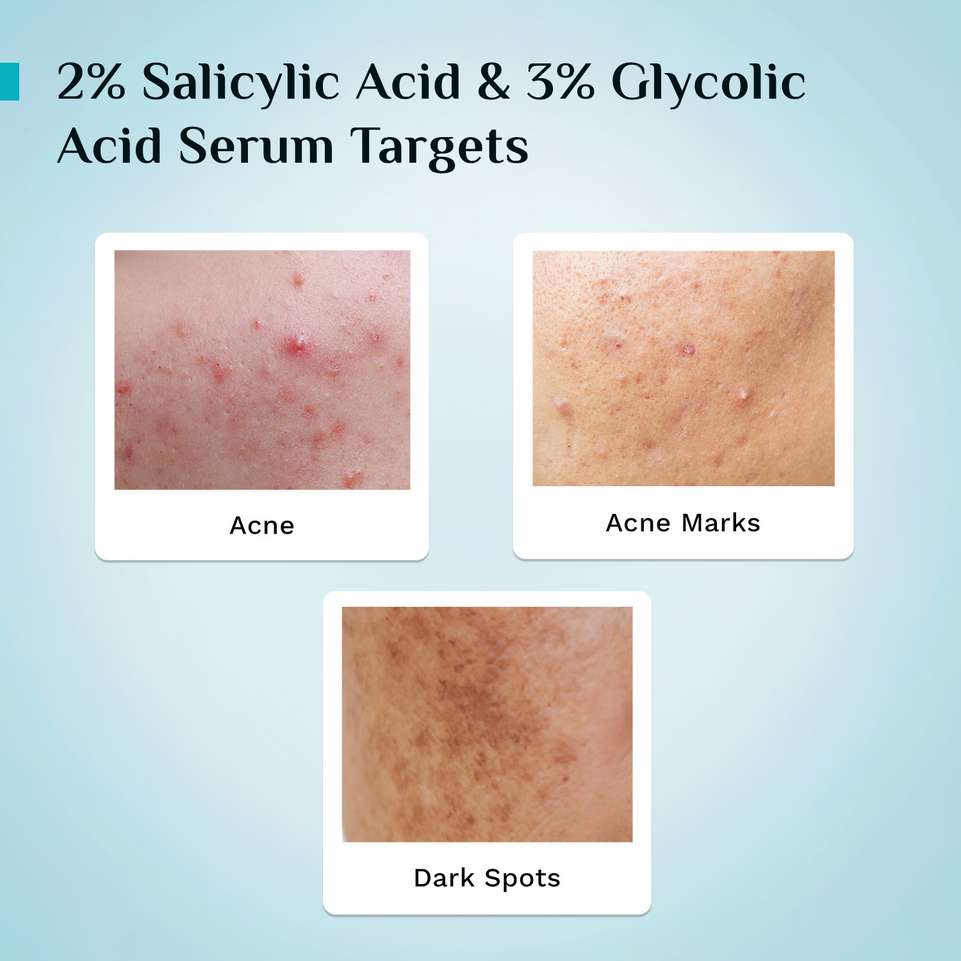 Shopsy Pilgrim Salicylic Acid 1% + Glycolic Acid 3% Anti Acne Serum - Image 6