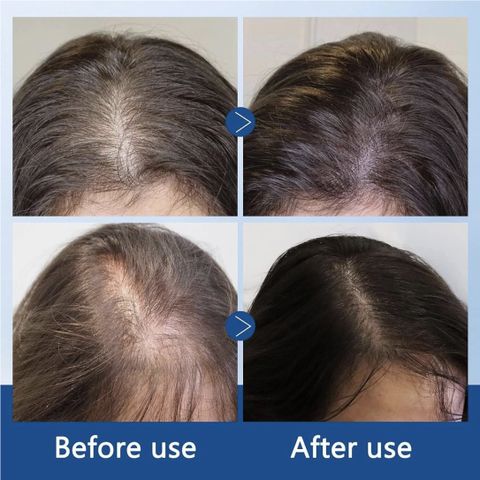 ALOTSA Hair Growth Roll On Serum for Fall Control, Root Strengthening & Scalp Care (10 ml) - Image 5