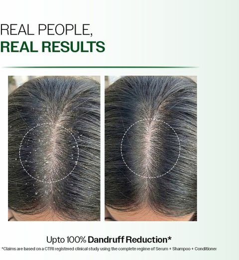 BARE ANATOMY Advanced Anti Dandruff Serum | Up to 100% Dandruff Reduction | For Men & Women (50 ml) - Image 8