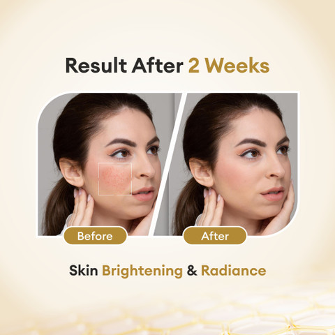 before and after glutathione cream CO Luxury with Kojic Acid,Vitamin A,C & E | Skin Whitening - Price in India, Buy CO Luxury Glutathione Cream with Kojic Acid,Vitamin A,C & E Primary sclerosing cholangitis - product interest_not face oils Style:NO LABEL