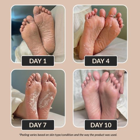LuxaDerme Korean Foot Peeling Mask, Pack of 2 (80 ml) - Image 4
