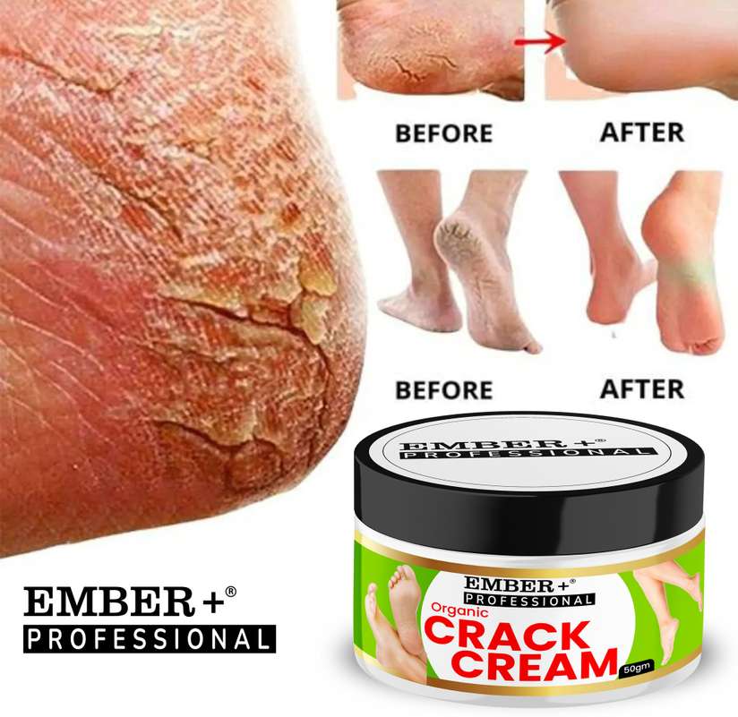 EMBER Ember Foot Cream For Rough, Dry and Cracked Heel, Feet Cream