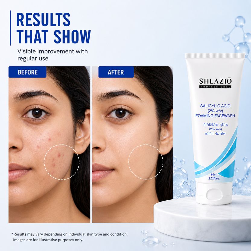 shlazio Salicylic Acid 2% for Acne - Image 5